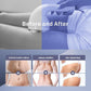 Radio Frequency Induced Heat-Palm NRG Cellulite Body Device