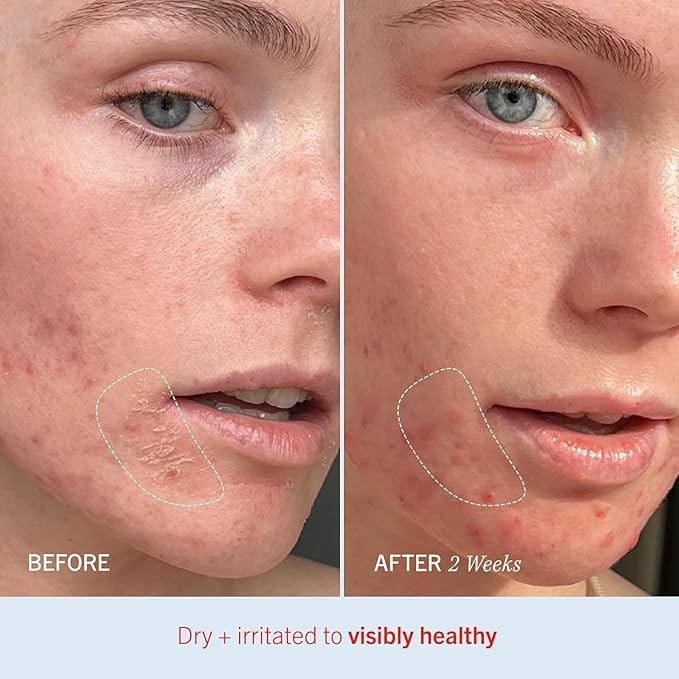 First Aid Beauty - Ultra Repair Cream, Intense Hydration Whipped Colloidal Oatmeal, Clinically Proven to Strengthen Skin Barrier & Help Relieve Eczema, Face & Body Moisturizer, 14 oz Vanilla Cinnamon